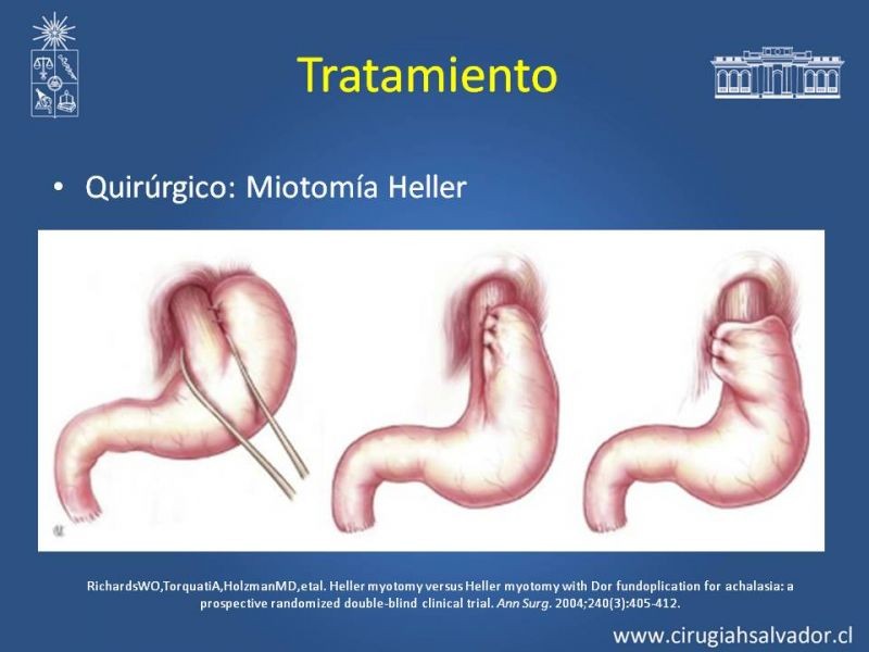Diapositiva 17 de Manejo Acalasia