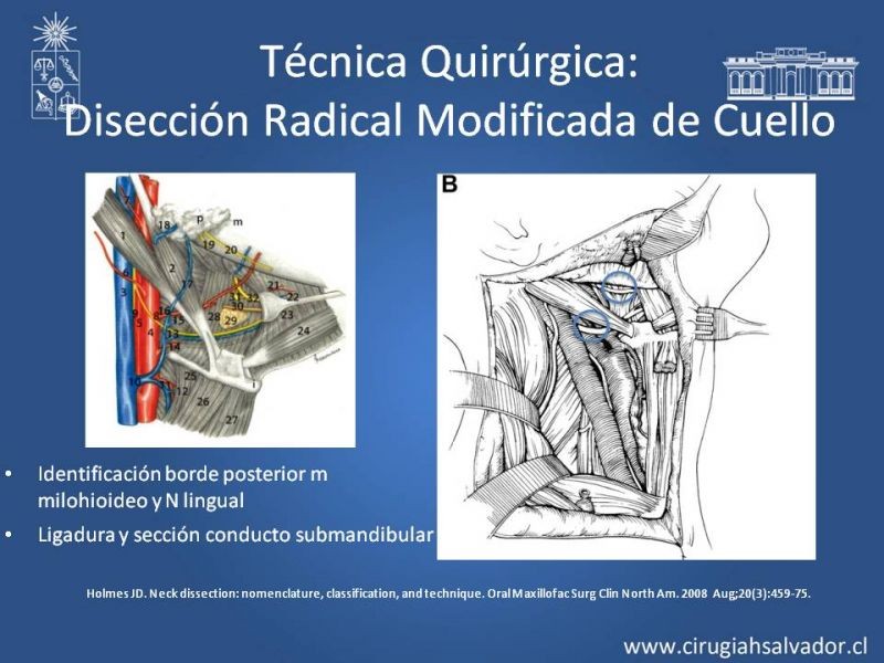 Diapositiva 58 de Técnica quirúrgica en disección cervical radical modificada