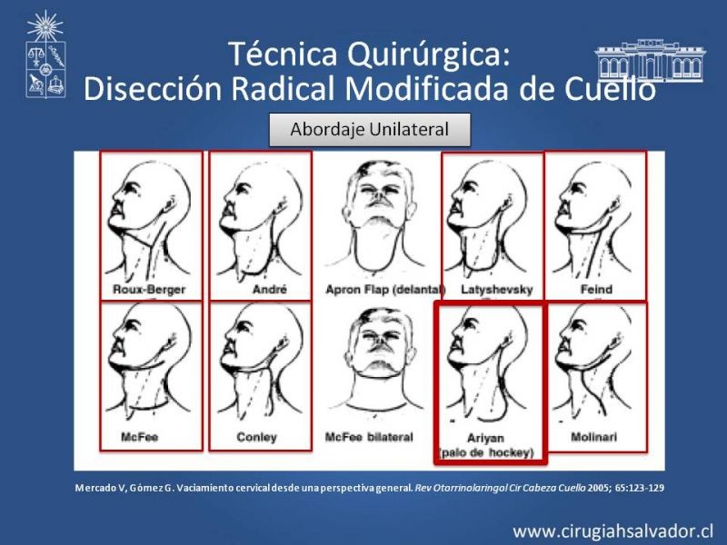 Diapositiva 46 de Técnica quirúrgica en disección cervical radical modificada
