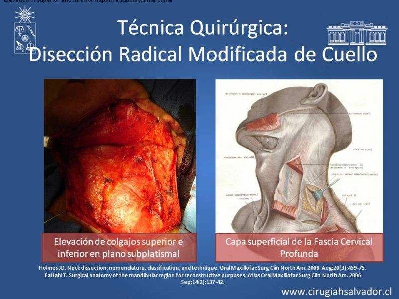 Diapositiva 50 de Técnica quirúrgica en disección cervical radical modificada