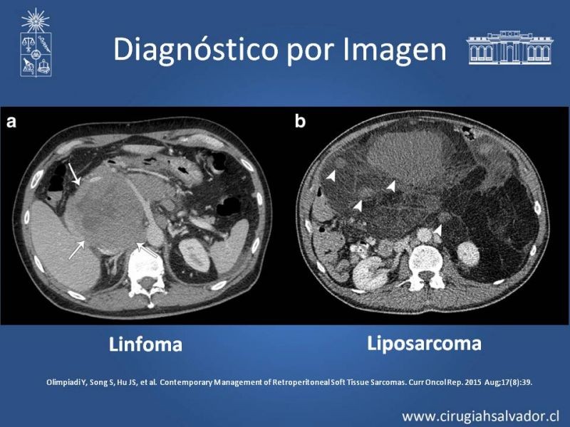Diapositiva 15 de Tumor Retroperitoneal: Estudio y manejo