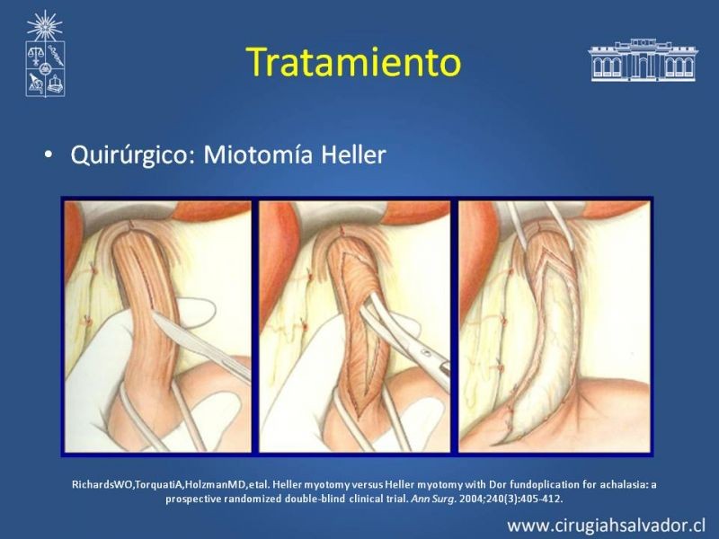 Diapositiva 16 de Manejo Acalasia