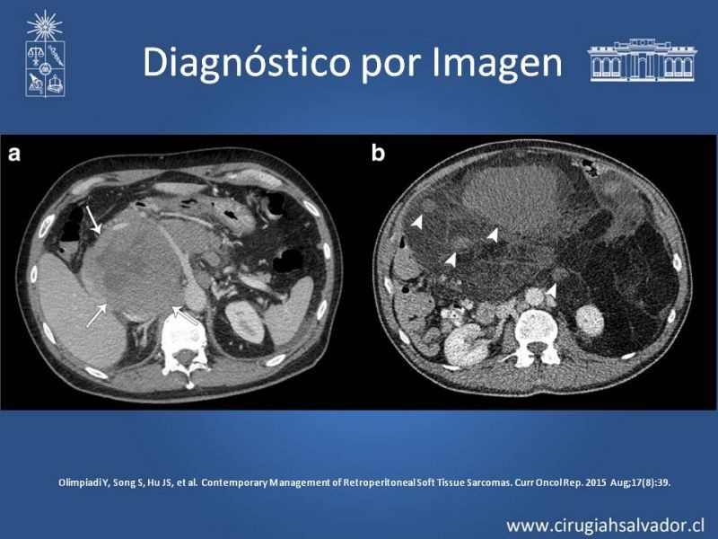 Diapositiva 14 de Tumor Retroperitoneal: Estudio y manejo