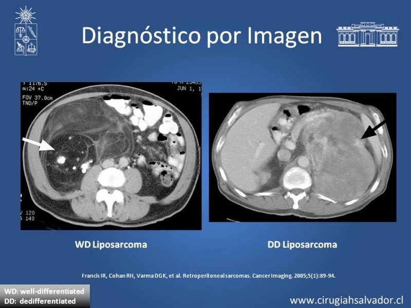 Diapositiva 16 de Tumor Retroperitoneal: Estudio y manejo