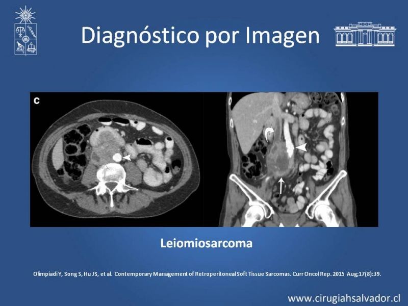 Diapositiva 17 de Tumor Retroperitoneal: Estudio y manejo