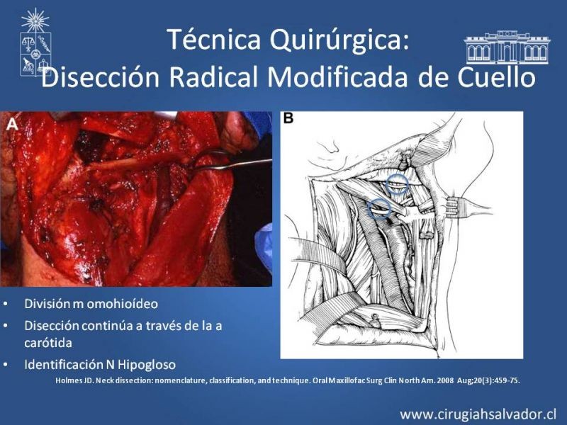 Diapositiva 57 de Técnica quirúrgica en disección cervical radical modificada