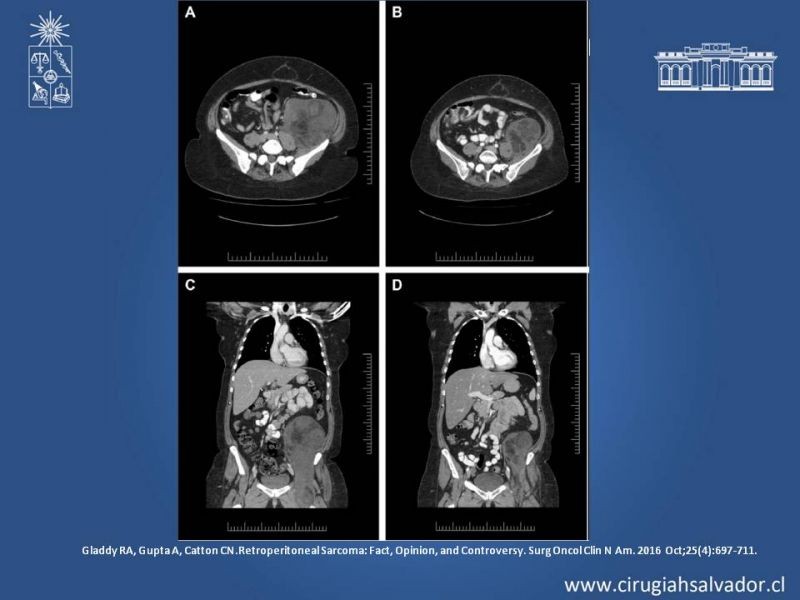 Diapositiva 53 de Tumor Retroperitoneal: Estudio y manejo