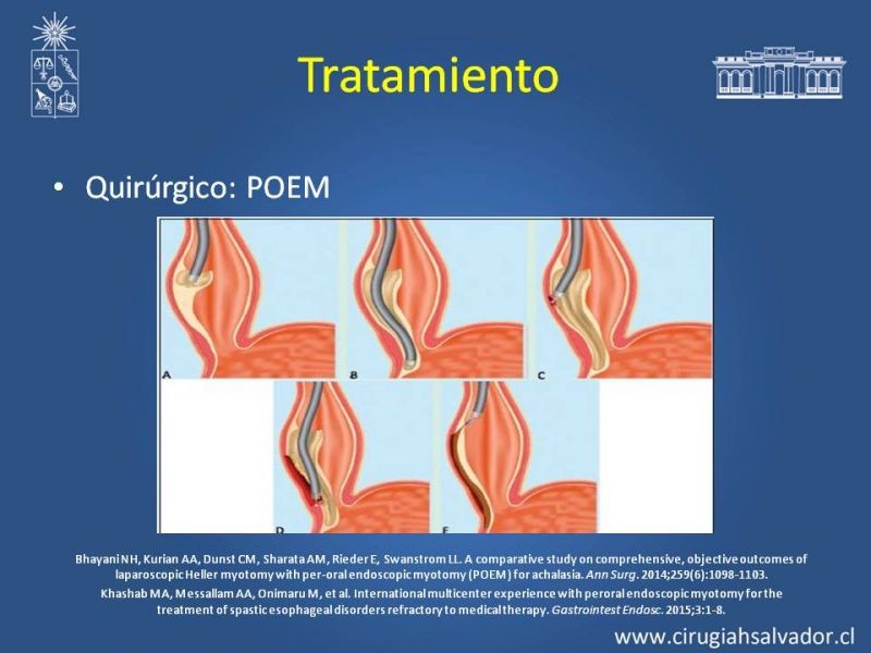 Diapositiva 21 de Manejo Acalasia