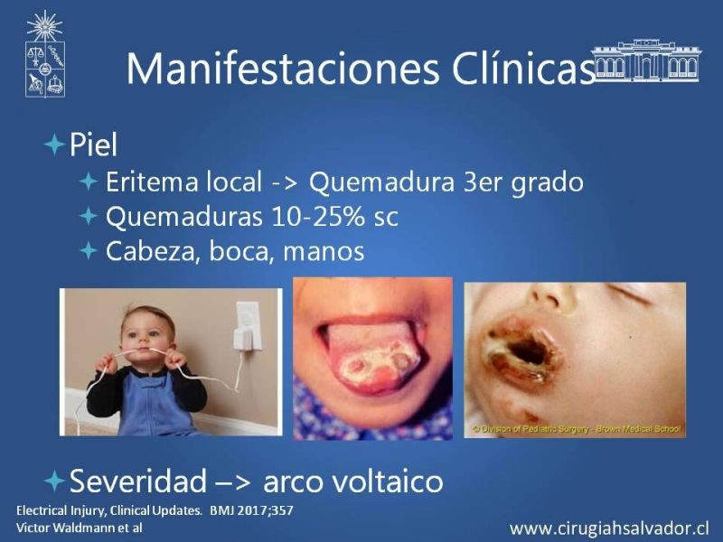 Diapositiva 16 de Quemaduras Eléctricas