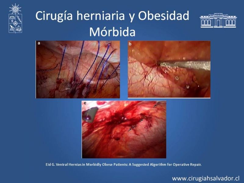Diapositiva 34 de Hernias Ventrales / Incisionales y Obesidad