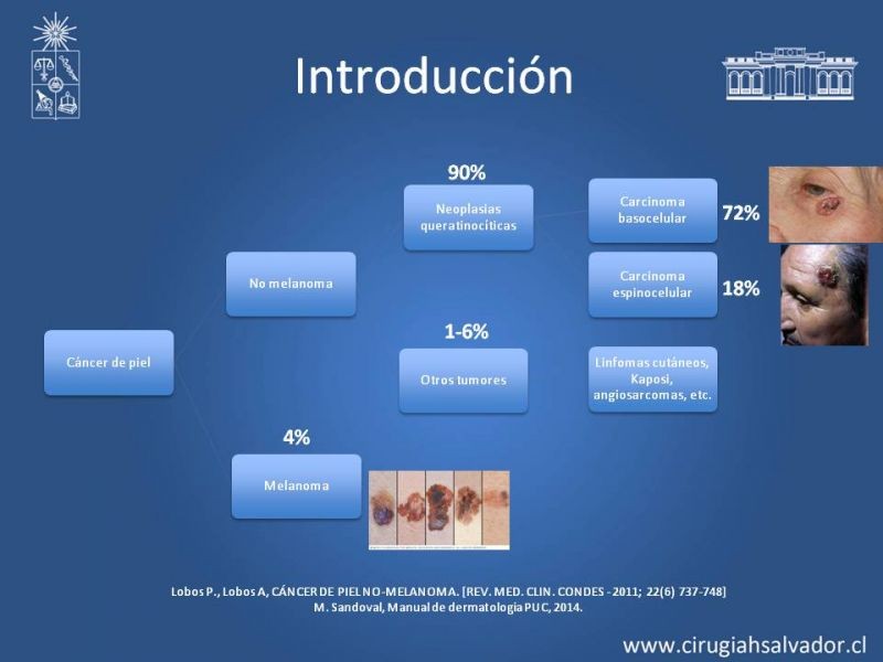 Diapositiva 2 de Cáncer espinocelular y ganglio centinela