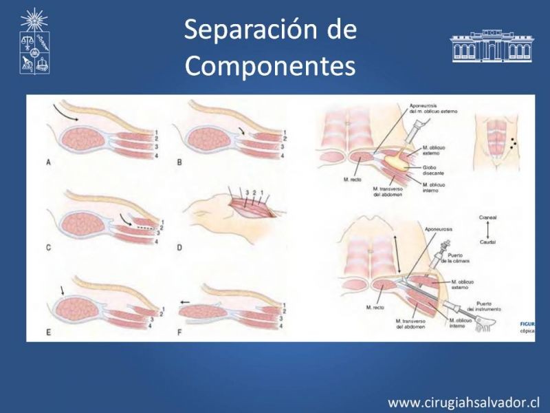 Diapositiva 14 de Hernias Ventrales / Incisionales y Obesidad