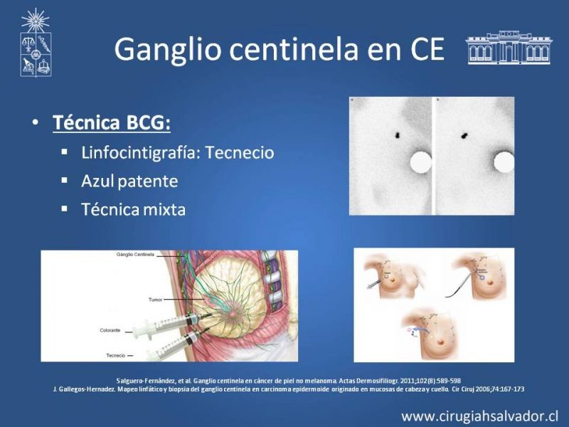 Diapositiva 17 de Cáncer espinocelular y ganglio centinela