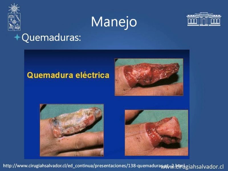 Diapositiva 25 de Quemaduras Eléctricas