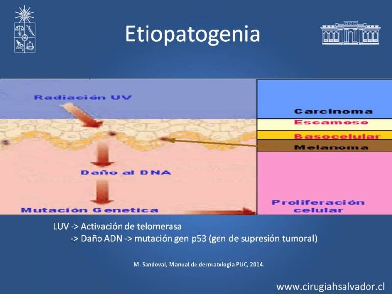 Diapositiva 7 de Cáncer espinocelular y ganglio centinela