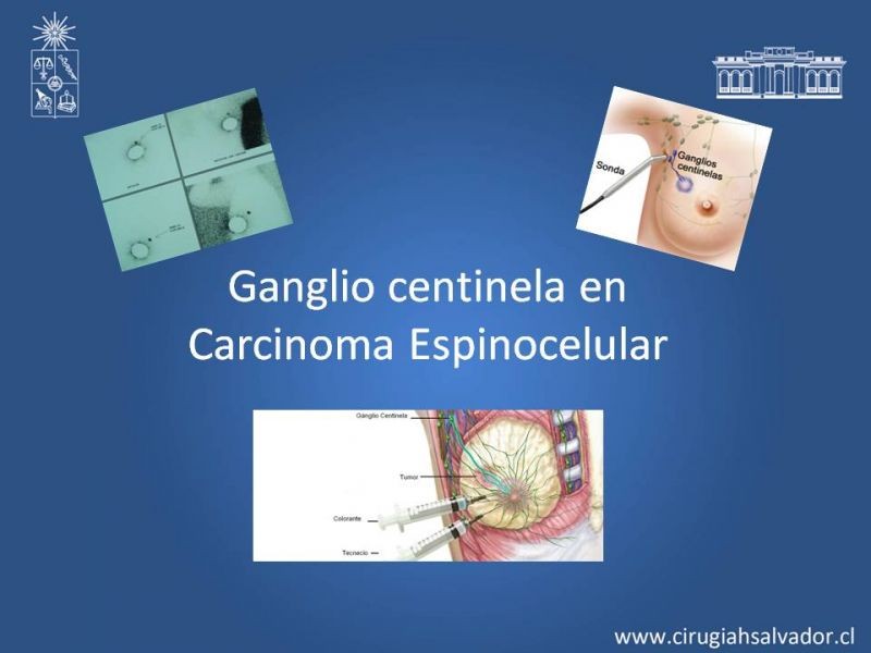 Diapositiva 15 de Cáncer espinocelular y ganglio centinela