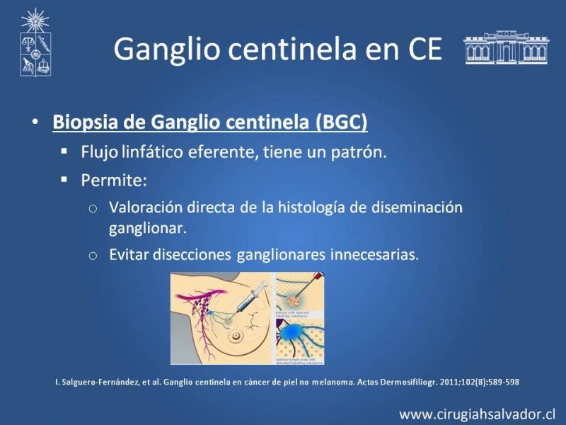 Diapositiva 16 de Cáncer espinocelular y ganglio centinela