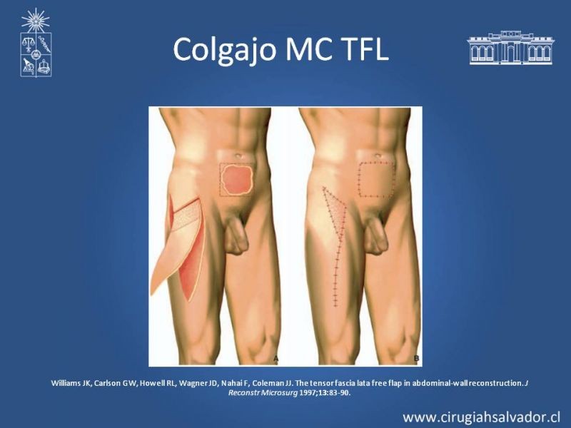 Diapositiva 33 de Úlceras por radionecrosis