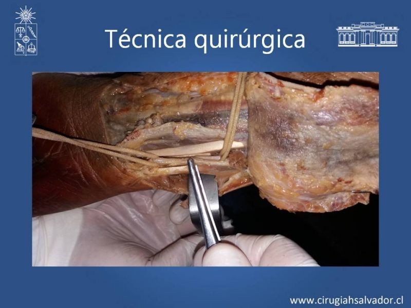 Diapositiva 24 de Anatomía quirúrgica y accesos vasculares: Arteria axilar, braquial, radial y ulnar