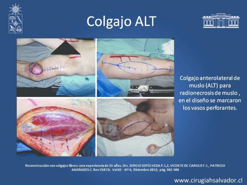Diapositiva 32 de Úlceras por radionecrosis