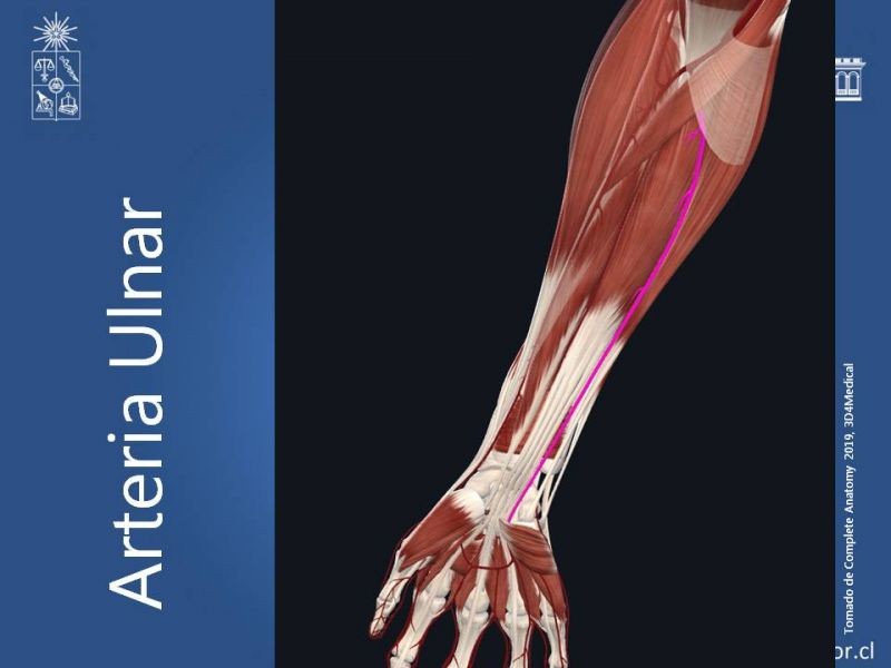 Diapositiva 21 de Anatomía quirúrgica y accesos vasculares: Arteria axilar, braquial, radial y ulnar