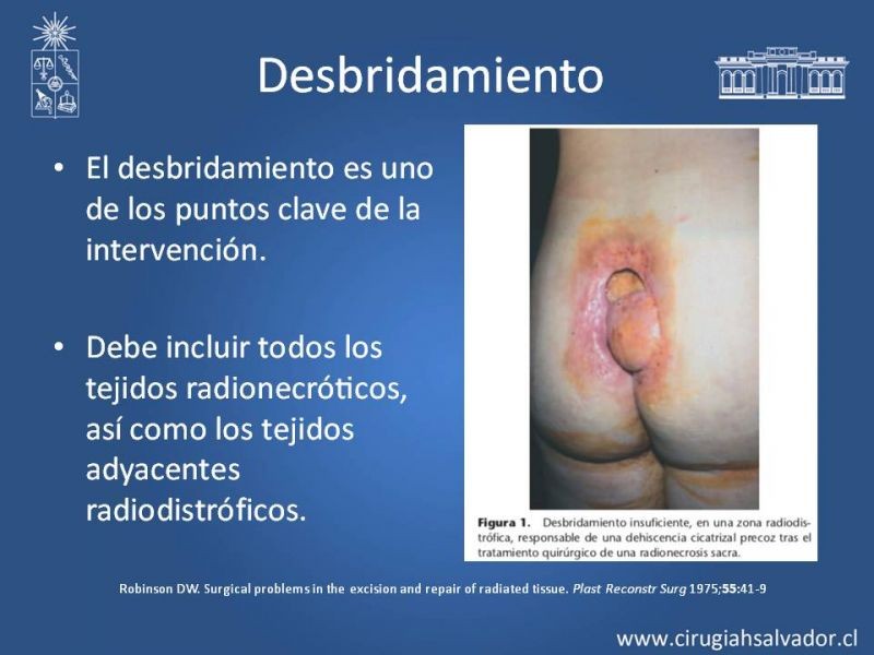 Diapositiva 23 de Úlceras por radionecrosis