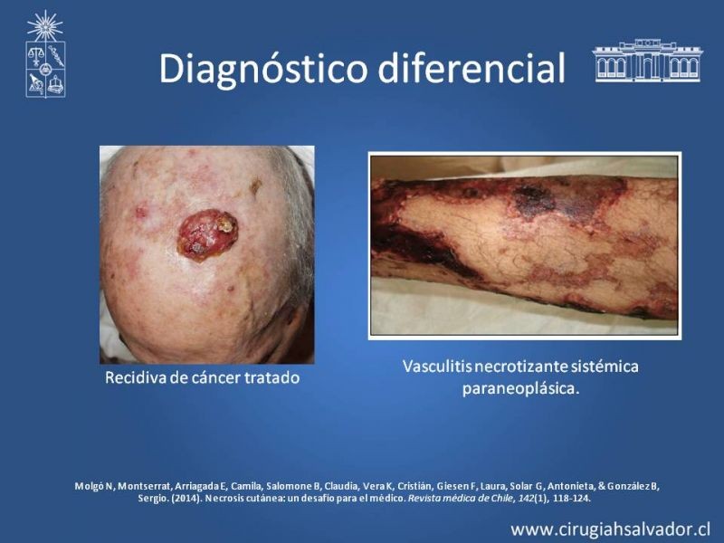 Diapositiva 15 de Úlceras por radionecrosis