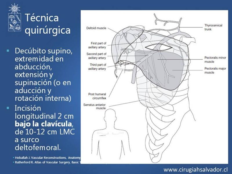 Diapositiva 6 de Anatomía quirúrgica y accesos vasculares: Arteria axilar, braquial, radial y ulnar