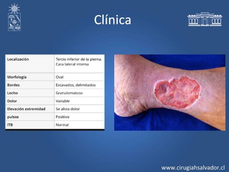 Diapositiva 12 de Úlceras de EEII: Diagnóstico diferencial y tratamiento