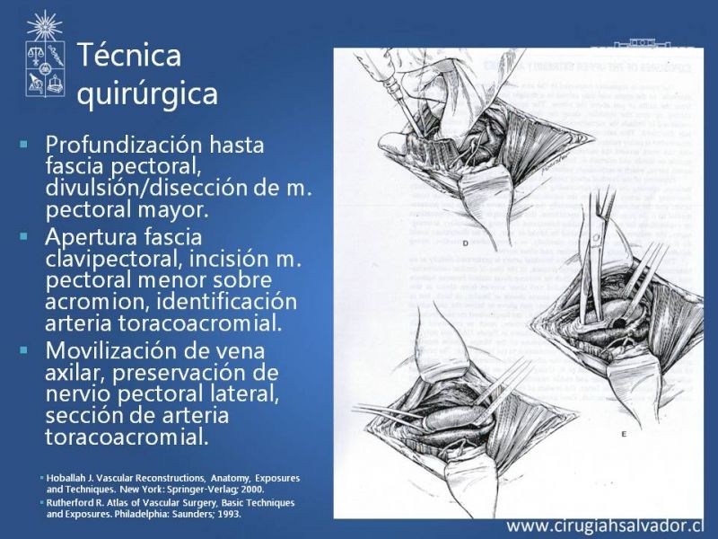 Diapositiva 7 de Anatomía quirúrgica y accesos vasculares: Arteria axilar, braquial, radial y ulnar