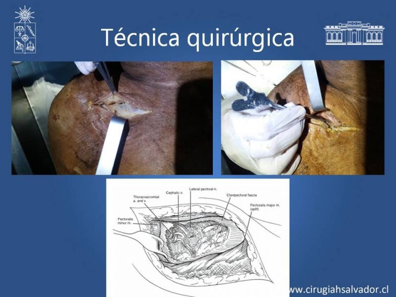 Diapositiva 8 de Anatomía quirúrgica y accesos vasculares: Arteria axilar, braquial, radial y ulnar