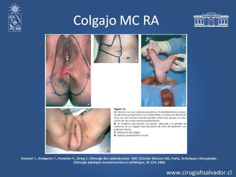 Diapositiva 35 de Úlceras por radionecrosis