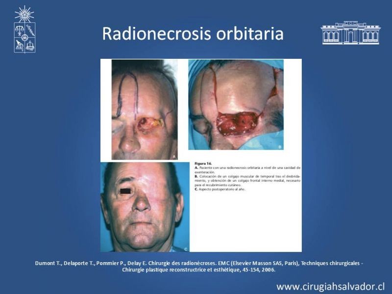 Diapositiva 36 de Úlceras por radionecrosis