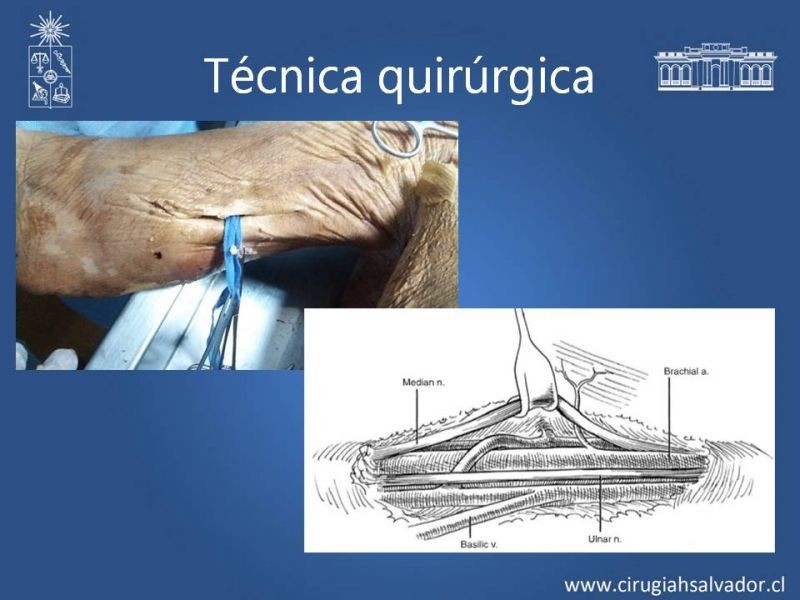 Diapositiva 13 de Anatomía quirúrgica y accesos vasculares: Arteria axilar, braquial, radial y ulnar