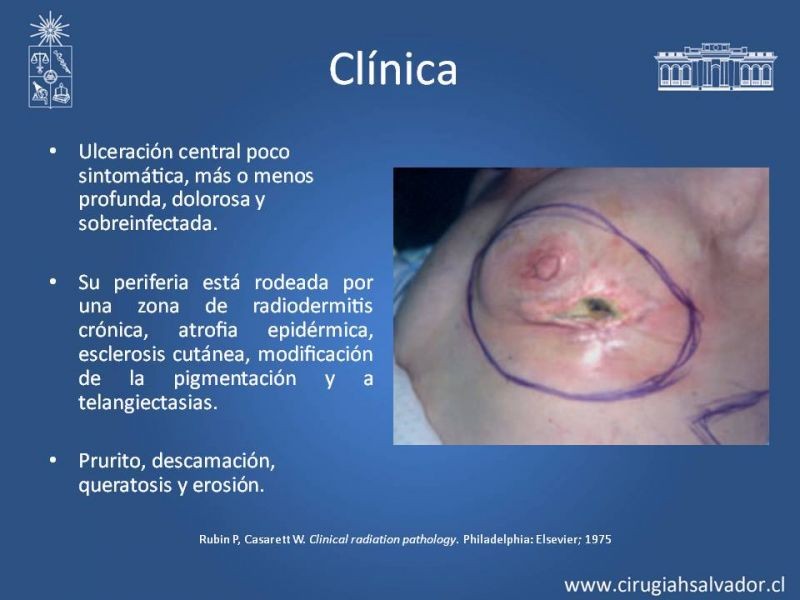 Diapositiva 13 de Úlceras por radionecrosis