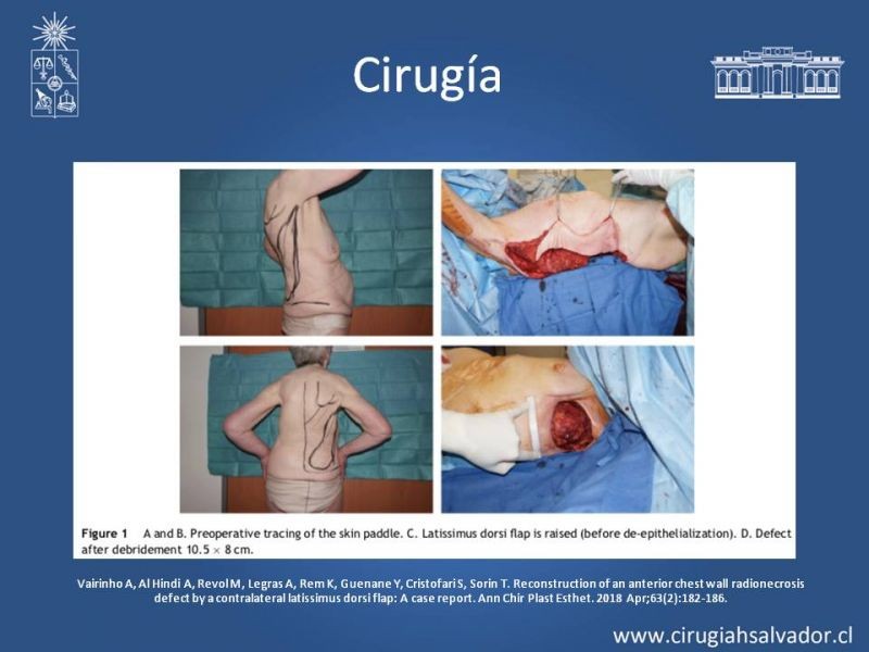 Diapositiva 26 de Úlceras por radionecrosis