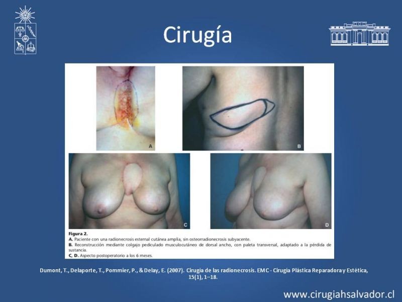 Diapositiva 25 de Úlceras por radionecrosis