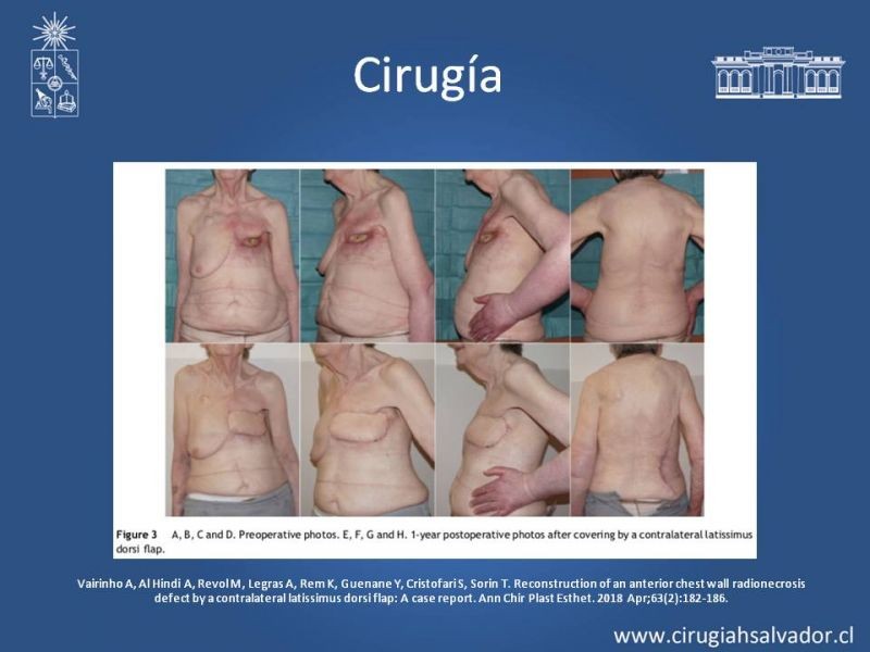 Diapositiva 28 de Úlceras por radionecrosis