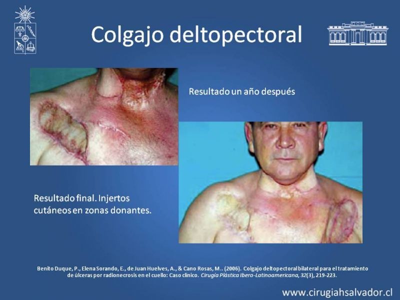 Diapositiva 31 de Úlceras por radionecrosis