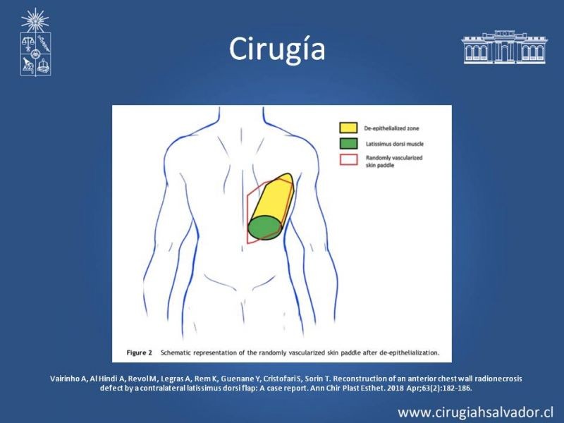 Diapositiva 27 de Úlceras por radionecrosis