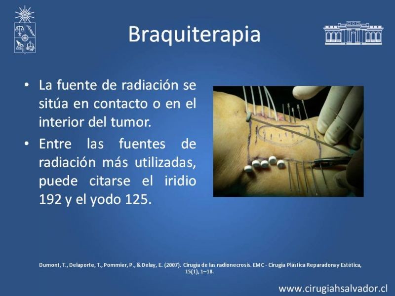 Diapositiva 5 de Úlceras por radionecrosis