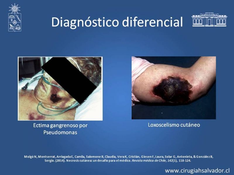 Diapositiva 16 de Úlceras por radionecrosis