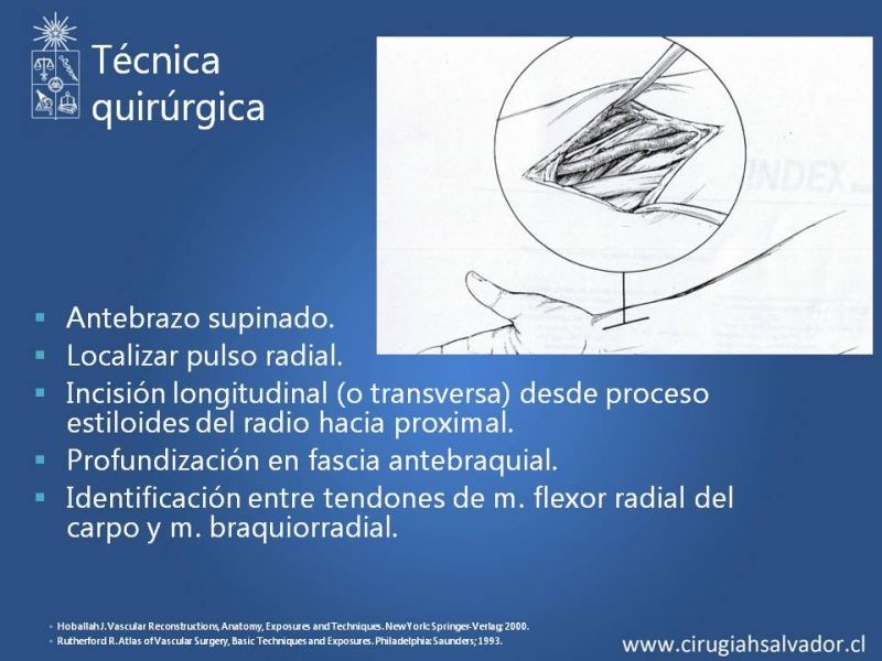 Diapositiva 19 de Anatomía quirúrgica y accesos vasculares: Arteria axilar, braquial, radial y ulnar