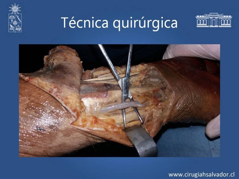 Diapositiva 20 de Anatomía quirúrgica y accesos vasculares: Arteria axilar, braquial, radial y ulnar