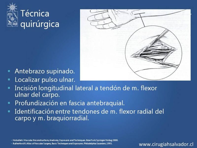 Diapositiva 23 de Anatomía quirúrgica y accesos vasculares: Arteria axilar, braquial, radial y ulnar