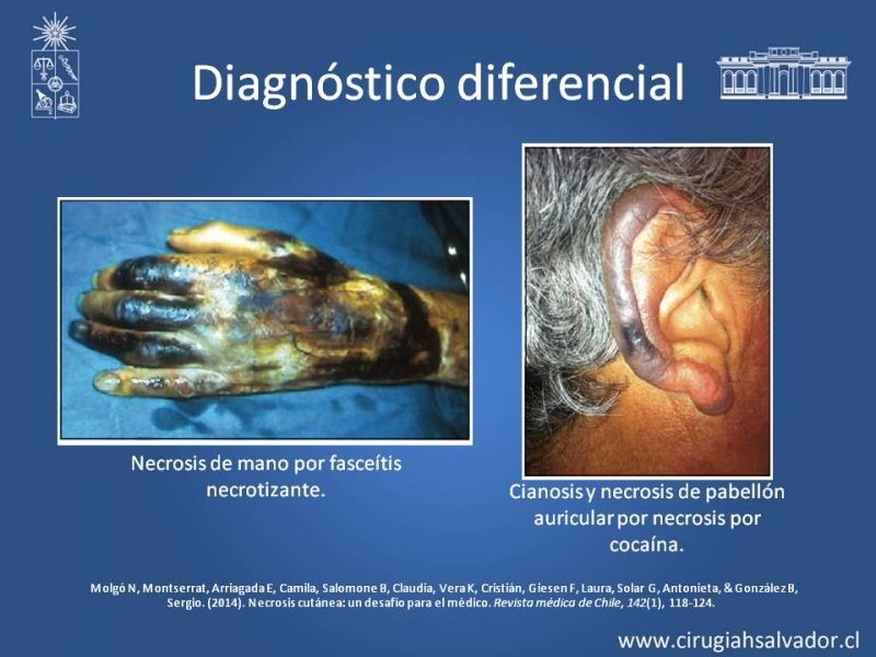 Diapositiva 17 de Úlceras por radionecrosis