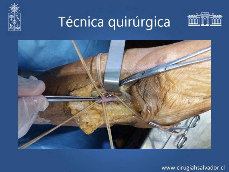 Diapositiva 16 de Anatomía quirúrgica y accesos vasculares: Arteria axilar, braquial, radial y ulnar