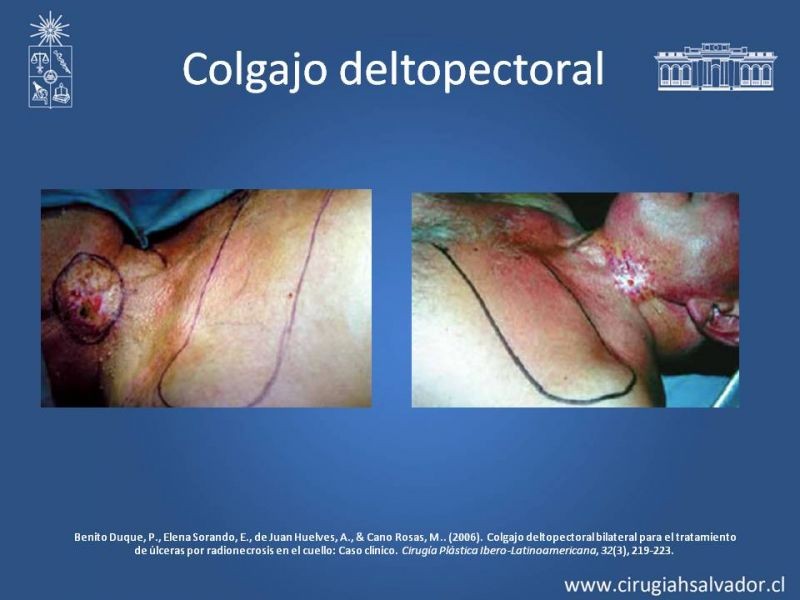 Diapositiva 30 de Úlceras por radionecrosis