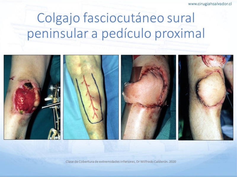 Diapositiva 36 de Cobertura de Extremidades Inferiores
