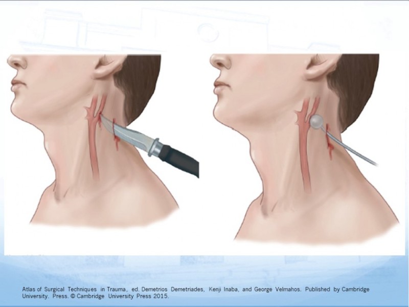 Diapositiva 21 de Trauma Cervical